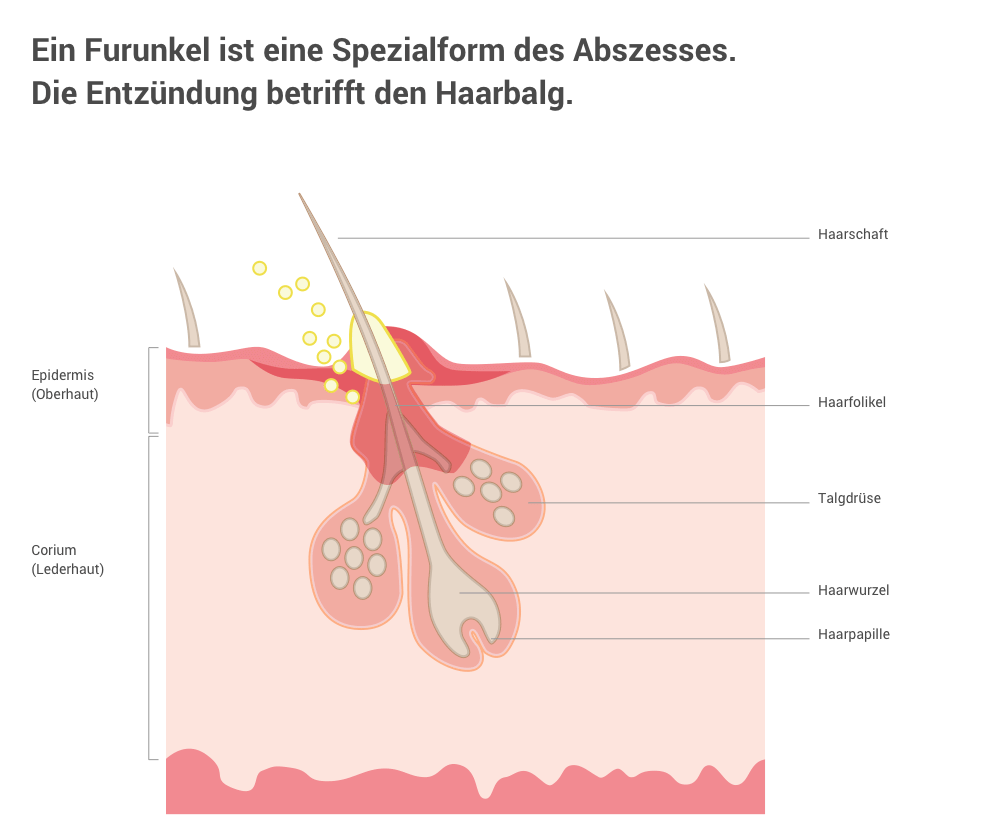 Pickel furunkel Furunkel behandeln: