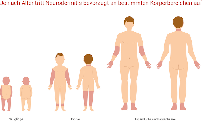 Je nach Alter sind von Neurodermitis unterschiedliche Körperbereiche betroffen