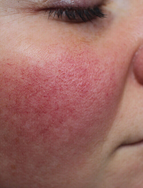 Rosacea bei schüssler salze Schüssler Salze