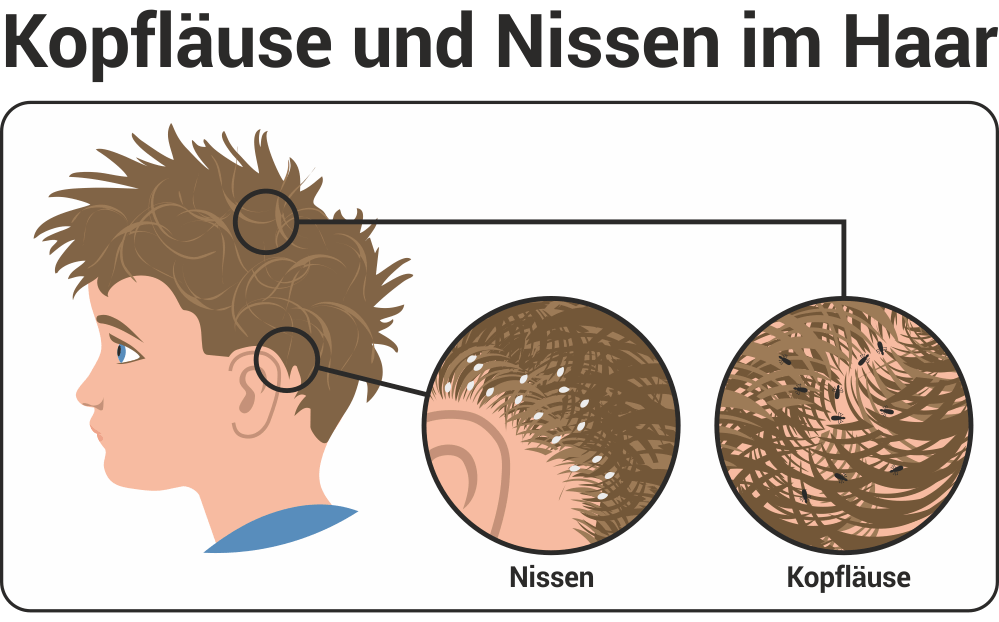 Kopfläuse und Nissen im Haar