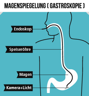 Mit Hilfe einer Magenspiegelung kann eine Gastritis festgestellt werden.