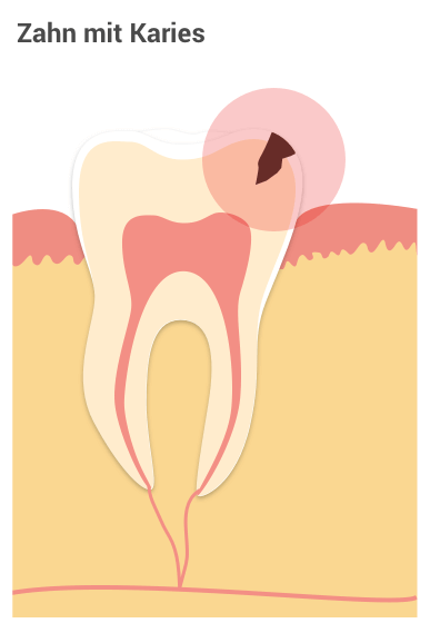 Zahn mit Karies